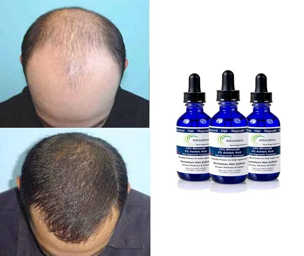 Миноксидил 15 купить. Миноксидил 15. Original Minoxidil 2022. Миноксидил 3 в 1. IISOLUTIONS миноксидил 15.