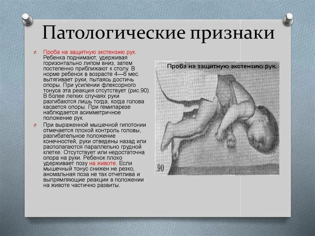 Вплоть симптом. Симптомы дцп у грудничка в 4 месяца. первые признаки дцп у грудного ребенка до 3 месяцев. дцп симптомы у детей до 1 года. дцп ранние признаки у новорожденного.