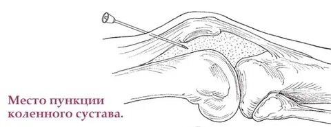 Пункция коленного сустава