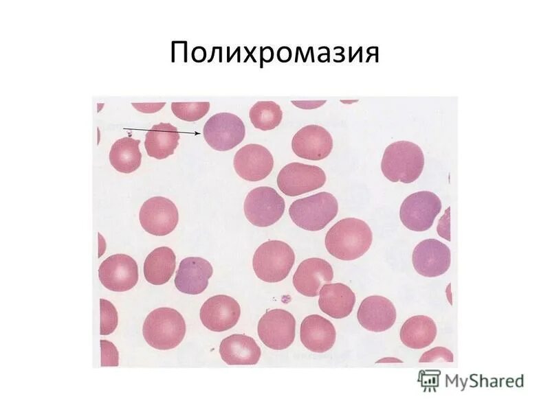 Пойкилоцитоз эритроцитов это. Пойкилоцитоз эритроцитов это