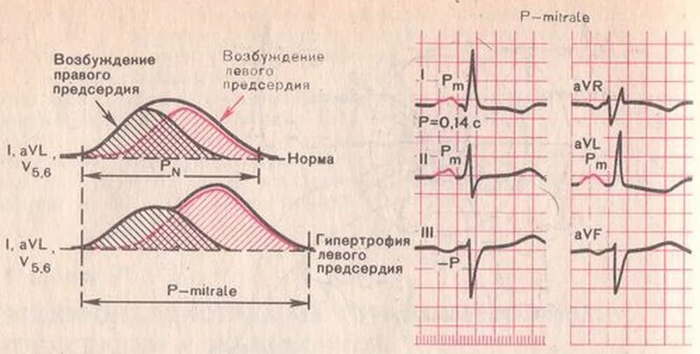 Гипертрофия предсердий на ЭКГ. Критерии гипертрофии левого предсердия на ЭКГ. Р mitrale на ЭКГ. Гипертрофия правого предсердия на ЭКГ. Норма правого предсердия