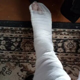 Сломанной ноги мужчина