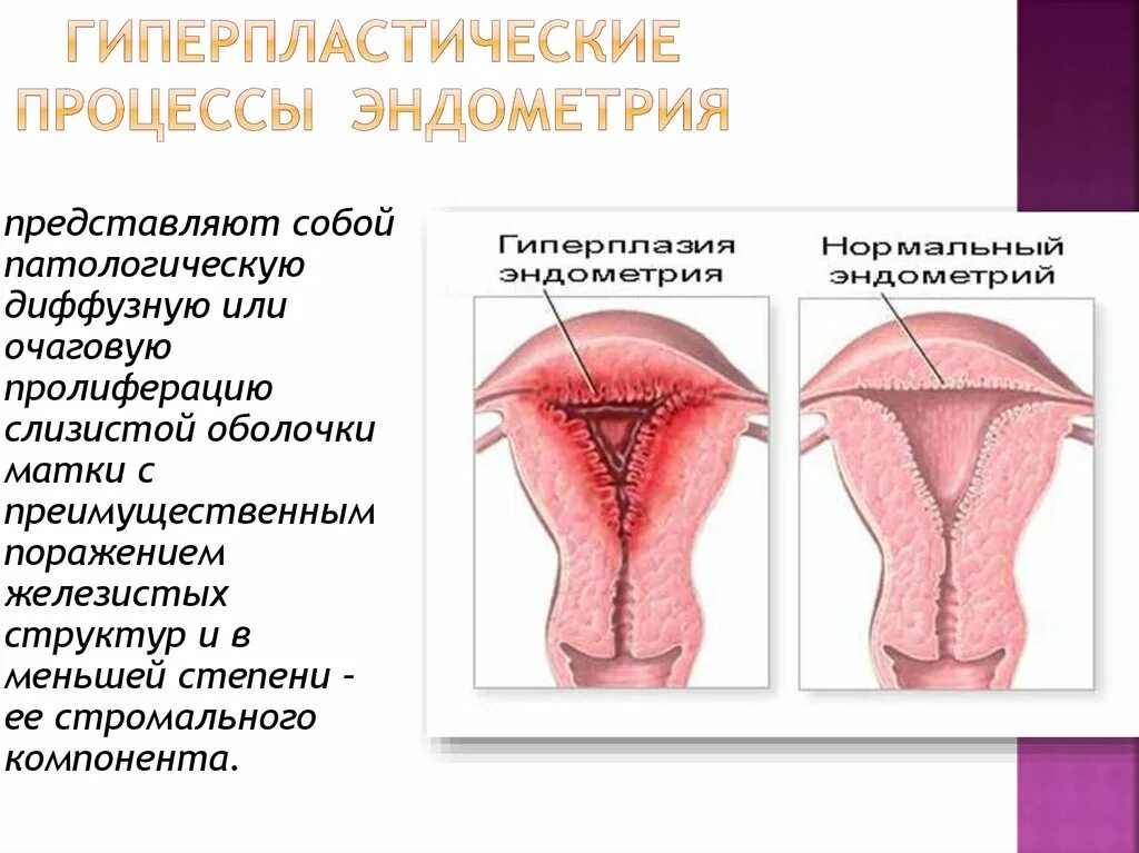 Как лечить эндометрий