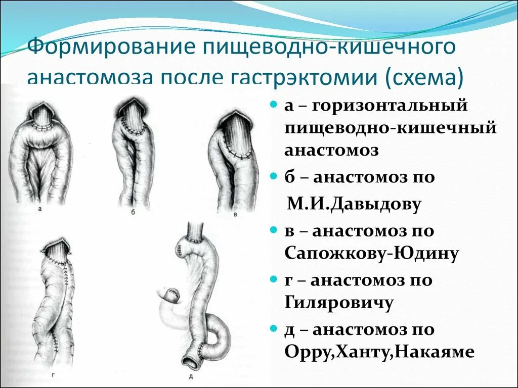 Пищеводно-кишечный анастомоз по Давыдову. Пищеводно желудочный анастомоз. Пищеводно кишечный анастомоз по Гиляровичу. Анастомозит что это