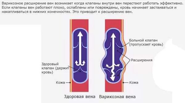 Расширение половых вен. Расширение половых вен. Варикозное расширение вагины. Яичниковая вена анатомия. Расширение половых вен.