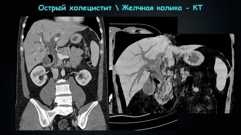 Разрыв брюшной полости