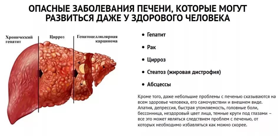 Боль печени после. Опасные заболевания печени.