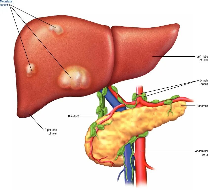 Как обследовать печень полностью. Liver. раковая печень человека.