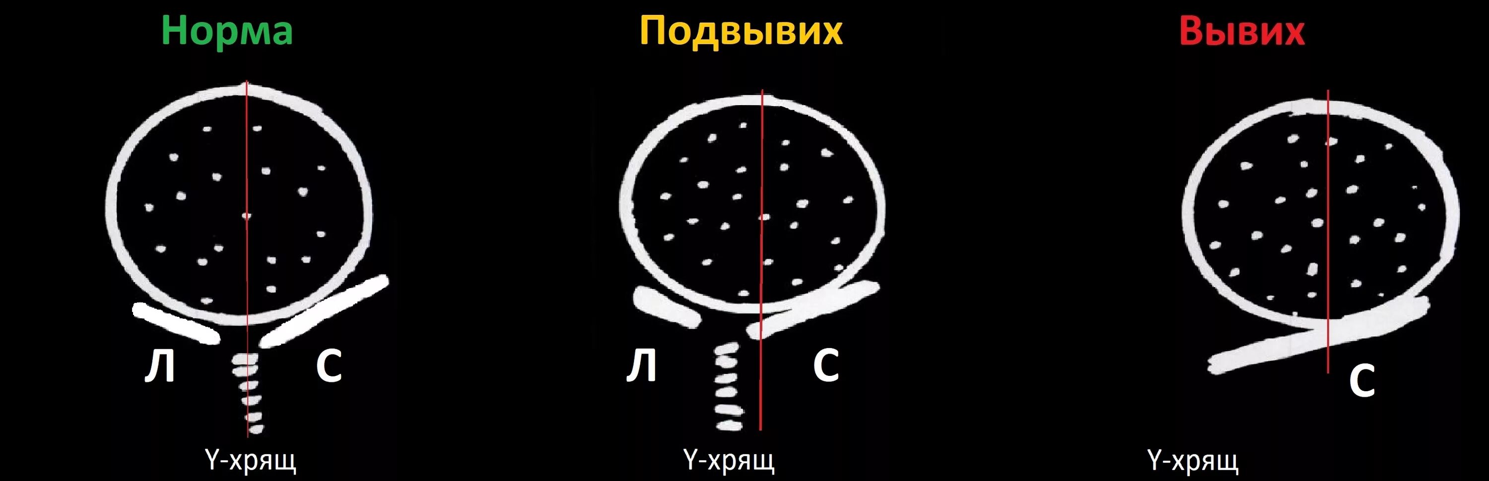 Норма углов тазобедренных. Узи тазобедренного сустава у новорожденных норма углов таблица. узи тбс у новорожденных нормы. угол шарпа. углы тазобедренных суставов у новорожденных норма узи.