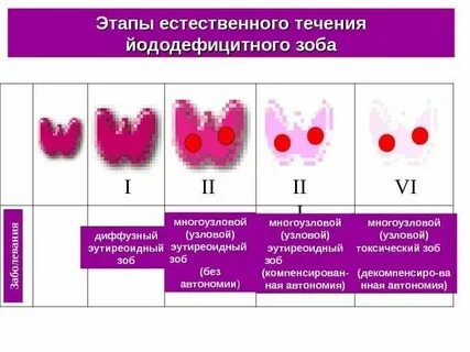 Многоузловой зоб 2 степени