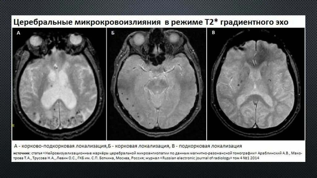 Микроангиопатия на мрт