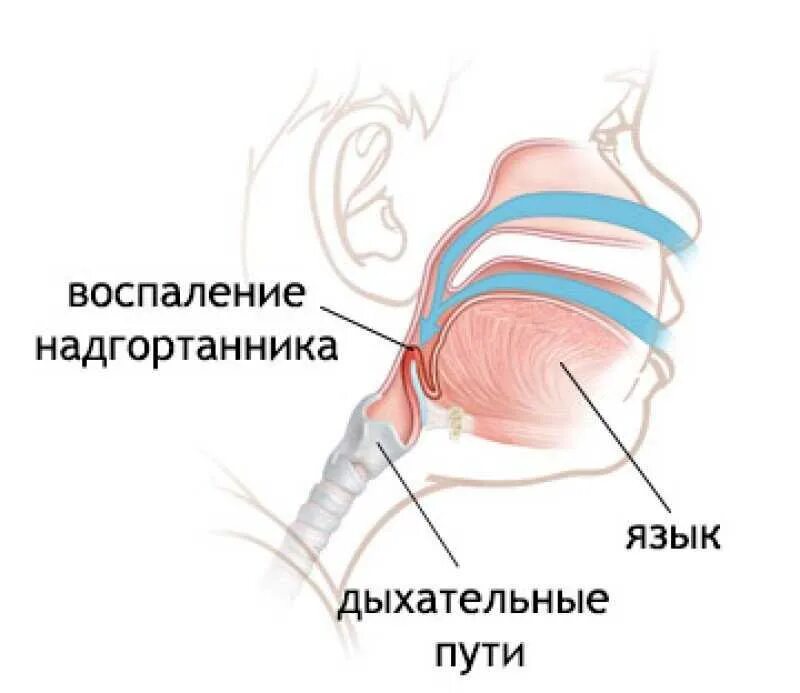 Эпиглоттит симптомы. Надгортанник при эпиглоттите. Абсцесс надгортанника клинические рекомендации. Воспаление над гортаника.