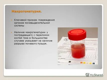 Нефрит гематурия