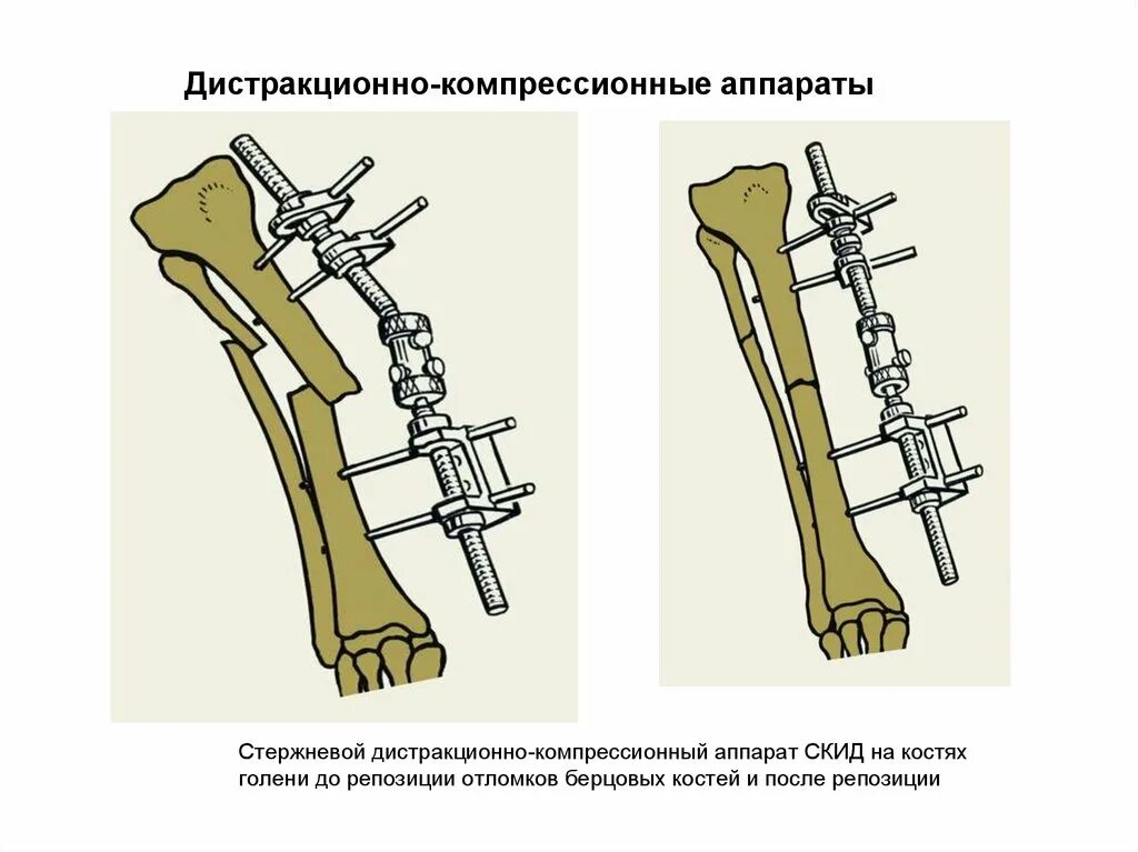 Чрескостный компрессионный остеосинтез. Стержневые аппараты внеочагового остеосинтеза. Внеочаговый чрескостный остеосинтез. Экстрамедуллярный (накостный) остеосинтез. Наружный остеосинтез.