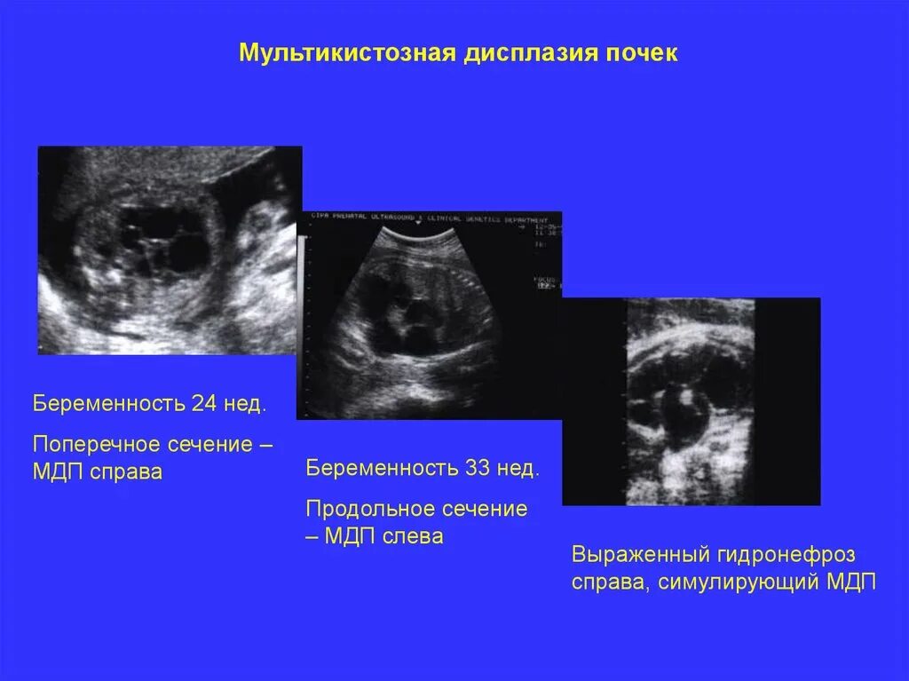 Почки у плода 20 недель. Мультикистозная дисплазия почки. Мультикистоз почки у плода. Кистозная дисплазия почек УЗИ. Мультикистозная дисплазия почки на УЗИ.