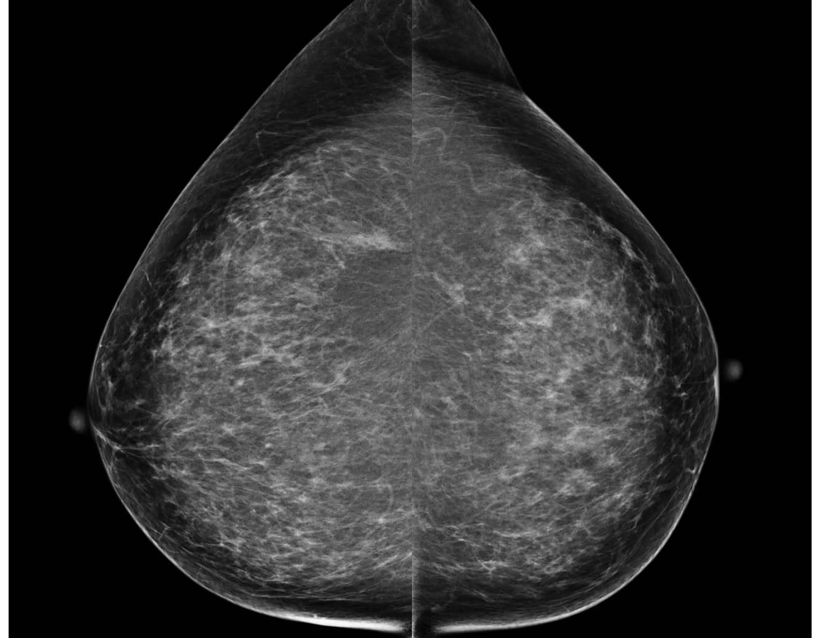 Печень и молочные железы. Маммография рентген молочной железы. Опухоль молочной железы маммограмма. Билатеральная маммография. DCIS молочной железы маммография.