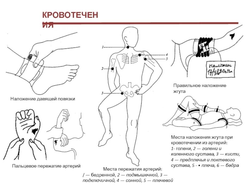 Жгут можно накладывать при кровотечении. Места наложения кровоостанавливающего жгута. Типичные места наложения жгута.