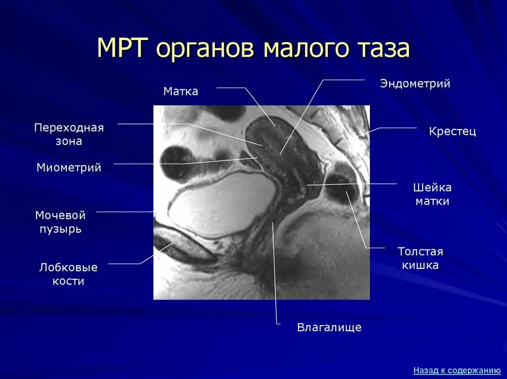 Передний свод. Мрт анатомия малого таза женщины.