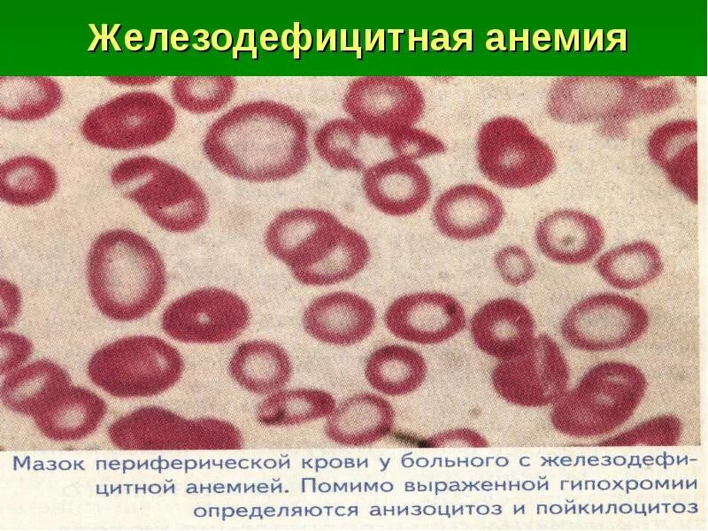 Малокровие эритроцитов. Микроскопия крови при железодефицитной анемии. Микроскопия эритроцитов при железодефицитной анемии. Жда эритроциты. Железодефицитная анемия мазок крови.