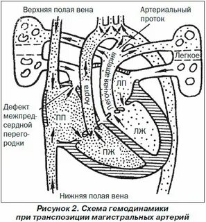 Корригированная транспозиция сосудов
