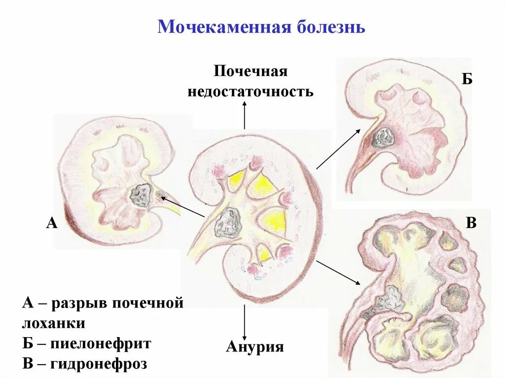 Возможные заболевания почек. Заболевания мочевыделительной системы мочекаменная болезнь. Локализация камней при мочекаменной болезни. Мочекаменная болезнь (urolithiasis). Моче-КАМНЕННАЯ болезнь.