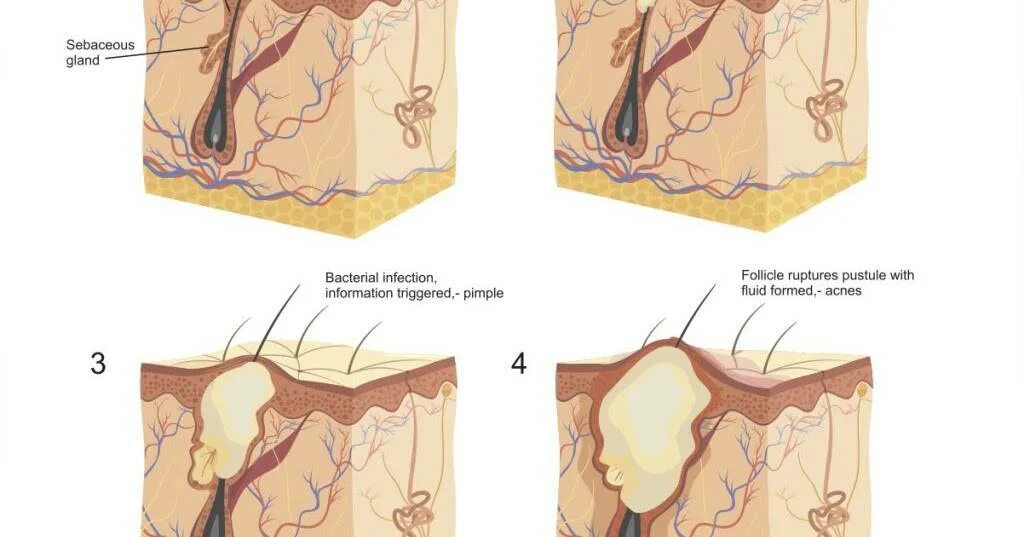 Атерома киста сальной железы. Атерома волосяного фолликула. Гиперплазия сальных желез.