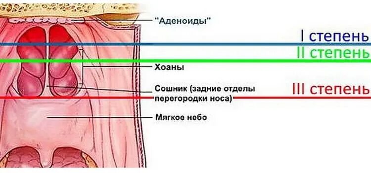 Аденоидные вегетации 1. Аденоиды 2-3 степени у ребенка. Аденоиды носоглотки 2 степени. Аденоидит 3 степени у ребенка. Симптомы аденоидита у детей.