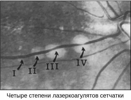 Периферические ретинальные дегенерации. Степени лазеркоагулятов сетчатки. Решетчатая дистрофия лазеркоагуляты. Лазеркоагуляты пигментированы. Периферические хориоретинальные дистрофии тактика ведения.