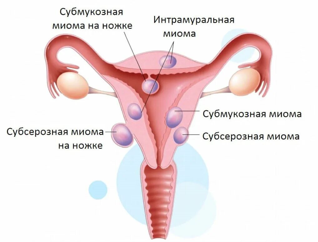 Миоматозный узел с дегенеративными изменениями. Жизнь с миомой матки. Миома матки субсерозной формы. Миома матки и беременность. Субмукозная миома матки.