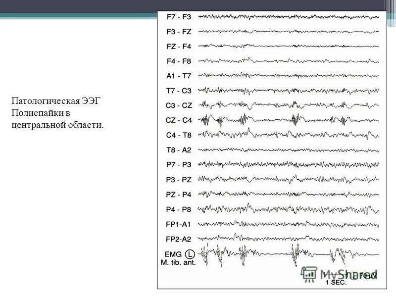 Делают ээг год. Исследование головного мозга ЭЭГ. Расшифровка электроэнцефалограммы головного мозга норма. Нормальная диаграмма ЭЭГ. Патологическая активность на ЭЭГ что это.