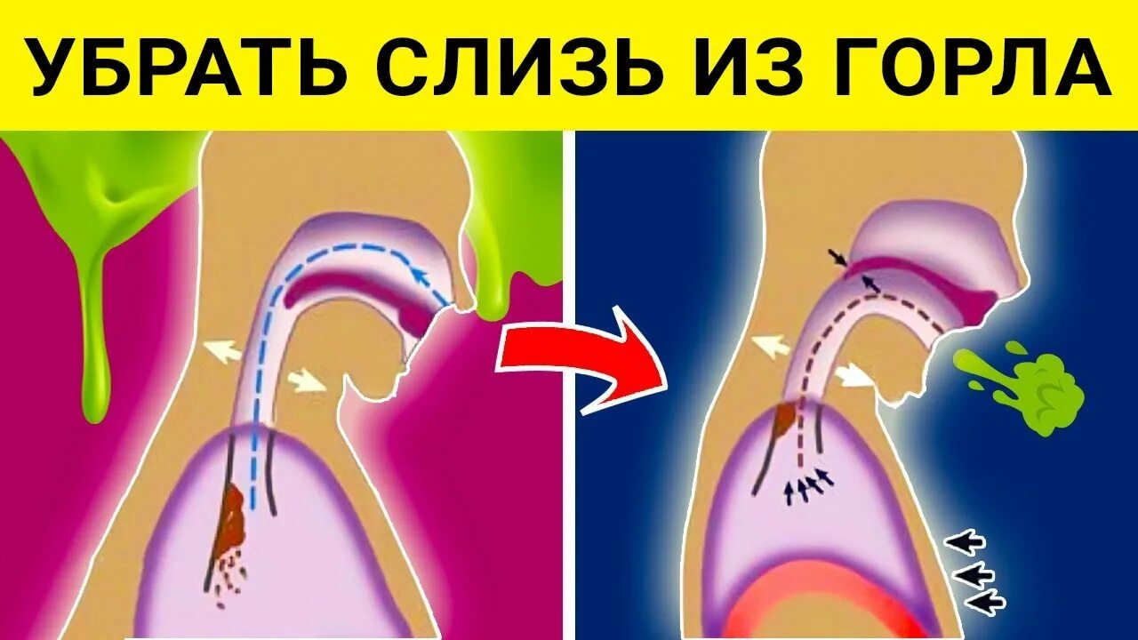 Как убрать мокроту в горле. Как убрать слизь в горле.