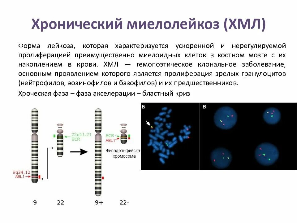 Болезнь миелолейкоз. Хронический миелолейкоз цитогенетика. ph-негативный хронический миелолейкоз. клинико-гематологические стадии хронического миелоидного лейкоза. хронический миелоцитарный лейкоз классификация.