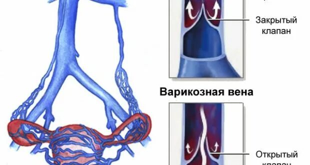Варикоз малого таза симптомы лечение. Варикозное расширение овариальных вен. варикозное расширение вен малого таза кт. эктазия вен малого таза.