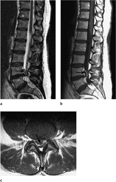 дорзальная протрузия l2/3 диска. межпозвоночная грыжа и экструзия. дорзальная грыжа экструзия диска. экструзия диска позвоночника l5-s1. дорзальная грыжа экструзия диска.