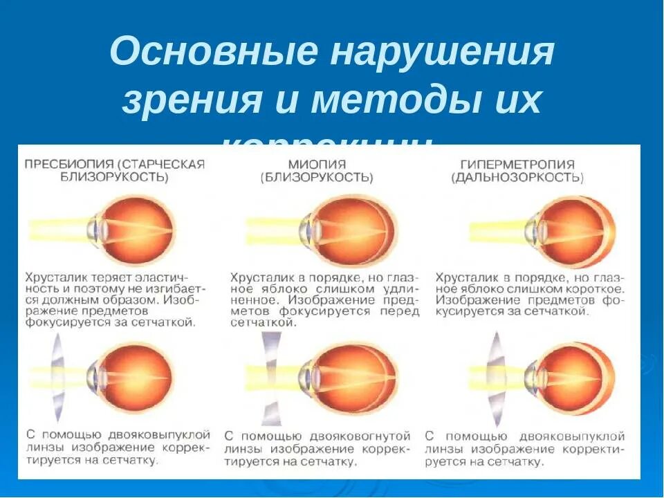 Нарушения зрения и их причины. Типы нарушения зрения. Виды зрительных нарушений. Главные причины нарушения зрения.