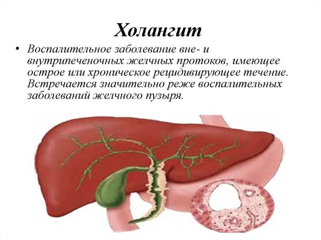 Заболеваний желчевыводящих