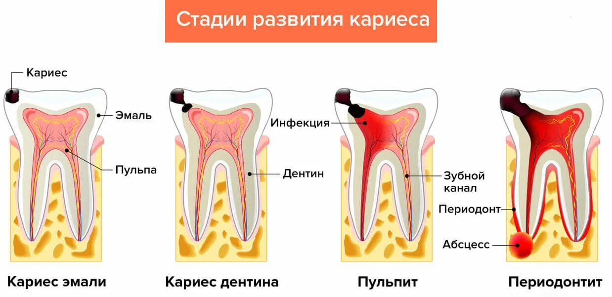 Этапы пульпита периодонтит. Кариес эмали дентина и цемента.