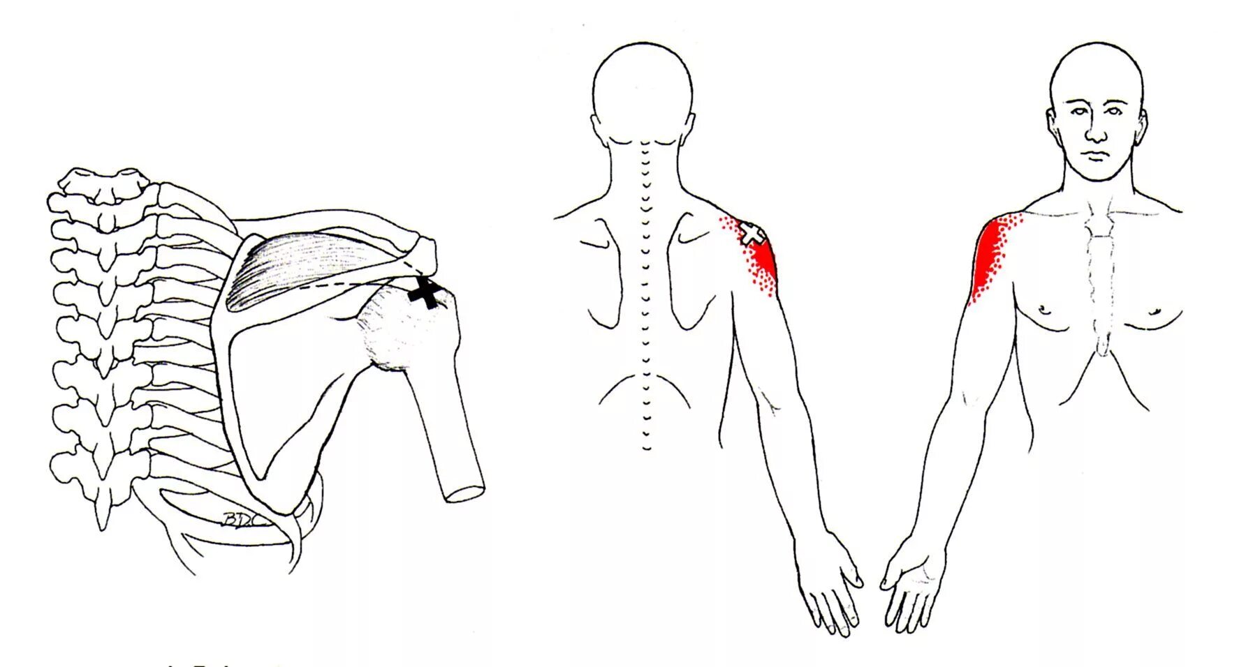Иррадиация боли в левую лопатку. Триггерные точки надостной. Надостная мышца триггерные точки. Триггерные точки плеча. Надостная мышца плечевого сустава триггерные точки.