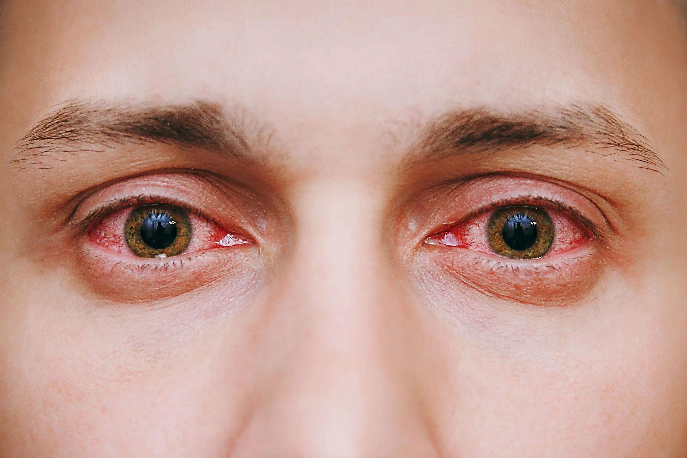 Проснулся болит глаз. Retouch4me Eye Vessels 1.010. Лимбальный кератоконъюнктивит. Красные глаза конъюнктивит.