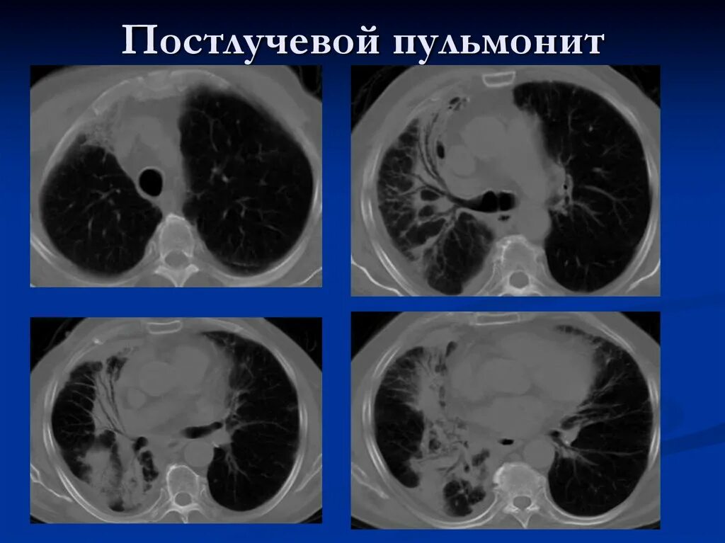 Кт после химиотерапии. Гиперсенситивный пневмонит на кт. Постлучевой пневмонит на кт. Гиперчувствительный пневмонит кт.