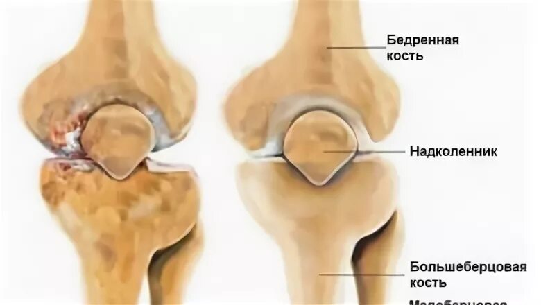 Коленных чашечек хруст усилился стократно песня