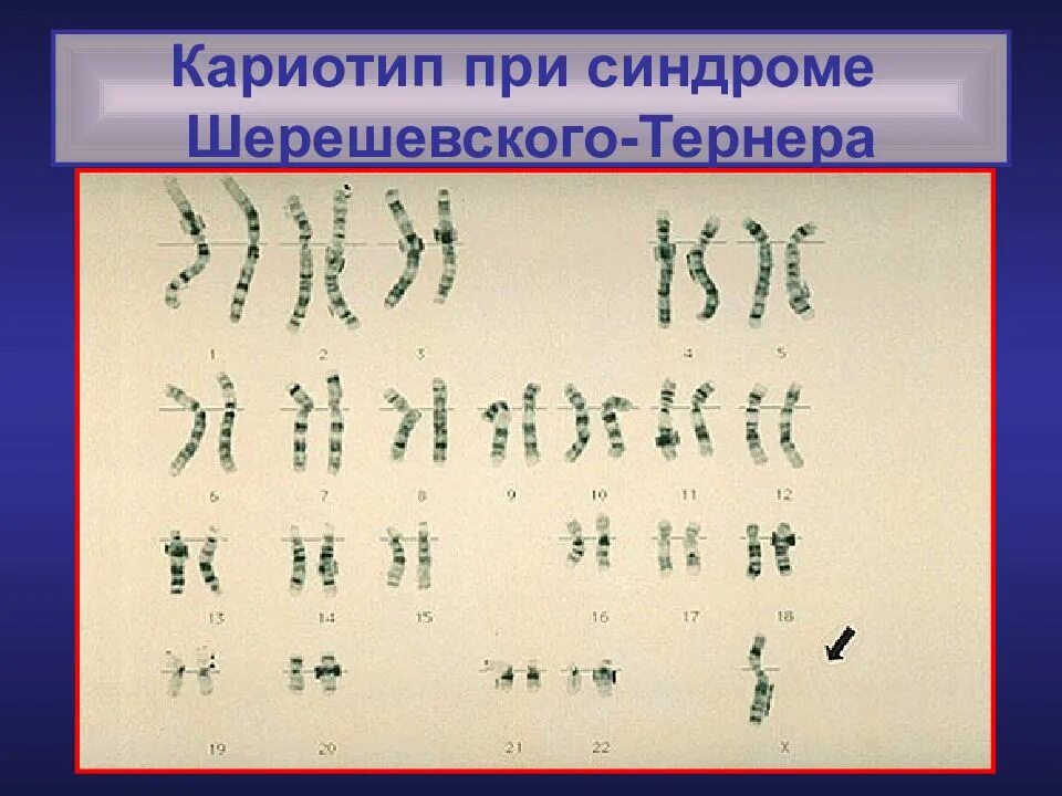 Кариотип человека генетика. Кариотип. кариотип при синдроме шерешевского-тернера. кариотип человека при синдроме шерешевского тернера. кариотипы синдромов.