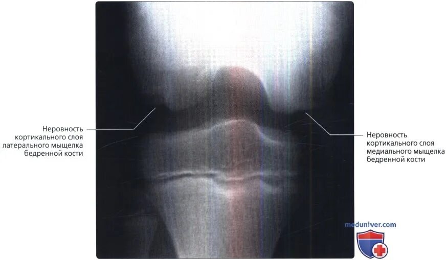 Хондромаляция медиальных мыщелков бедренной кости. Кортикальный гиперостоз. Кортикальный перелом латерального мыщелка. Кортикальный слой кости на рентгене. Кортикальный перелом латерального мыщелка бедренной кости.