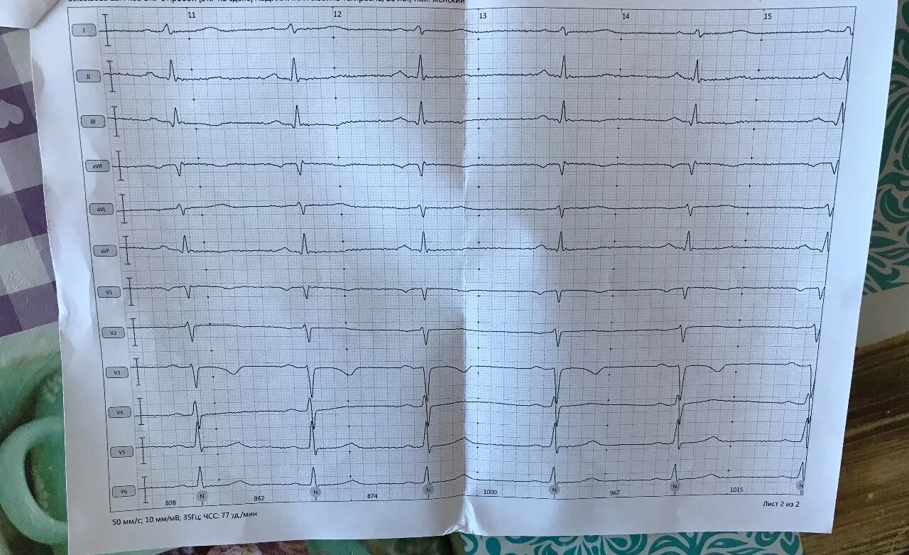 Экг сердца москва. Плохая кардиограмма. Плохое ЭКГ. ЭКГ сердца. Плохое ЭКГ сердца.