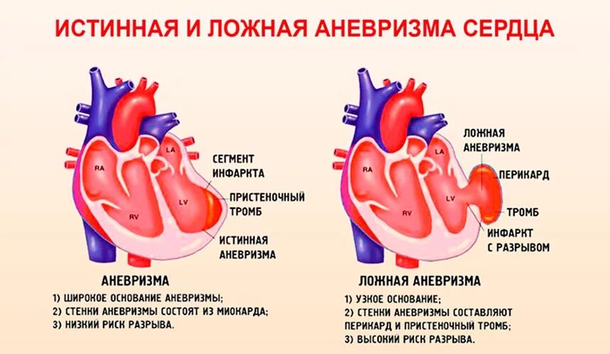 Сердцем отличай. Истинная и ложная аневризма сердца. Аневризма и ложная аневризма сердца. Классификация аневризм сердца. Постинфарктные аневризмы сердца.