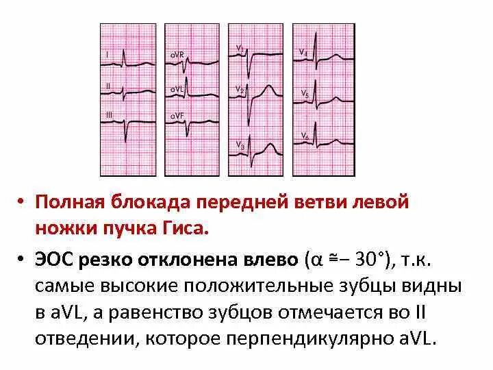 Полная блокада ножек гиса лечение. Блокада передней ветви ЛНПГ на ЭКГ. ЭКГ при блокаде передней ветви левой ножки пучка Гиса. Блокады ветвей пучка Гиса на ЭКГ. Блокада передней ветви ЛНПГ на ЭКГ признаки.