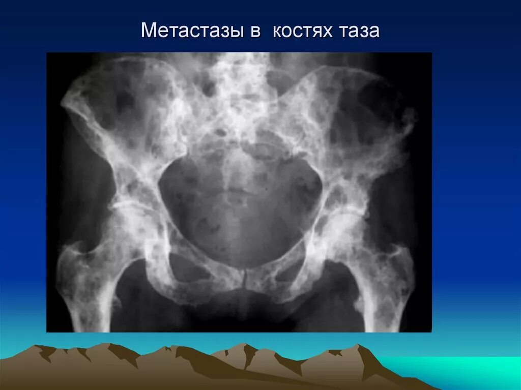 Метастазы в кости при раке предстательной. Остеобластические метастазы в кости таза рентген. Остеолитические метастазы в костях таза кт. Гигантоклеточная опухоль таза кт. Остеобластические метастазы костей таза на рентгене.