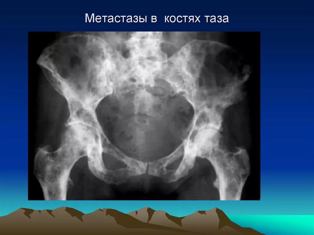 Метастазы в тазу. Остеобластические метастазы в кости таза рентген. остеолитические метастазы в костях таза кт. метастазы костей таза кт. гигантоклеточная опухоль таза кт.