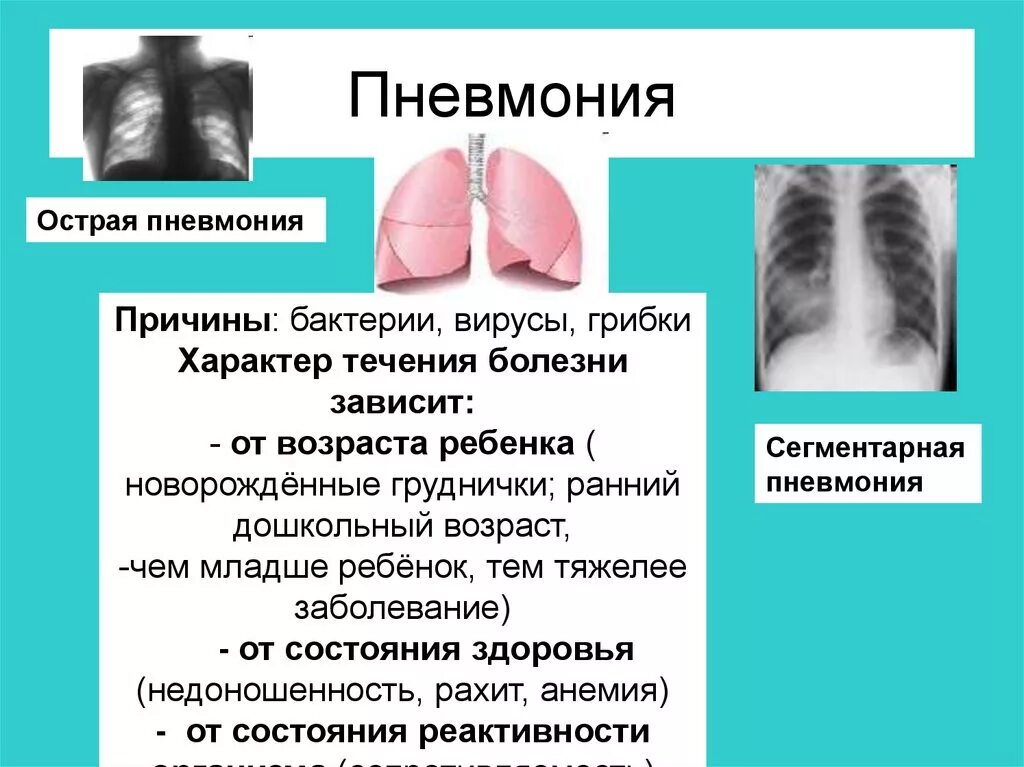 Пневмония легких симптомы у детей
