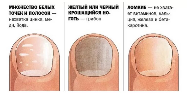 Ребристые ногти причина у мужчин. Ногтевая пластина. Изменение ногтевой пластины. Былые пятнвшки на ногтях.